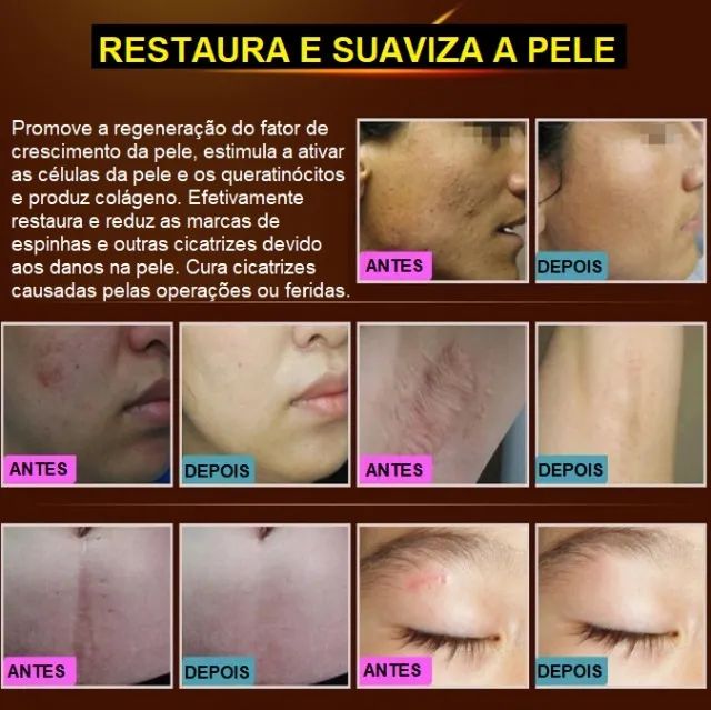 2Un. LANBENA Creme Para Tratamento De Cicatrizes 30g Cada - Foto 2
