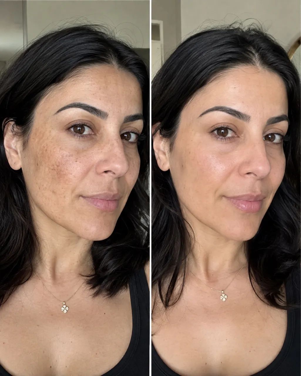 Remova melasma - Foto 2