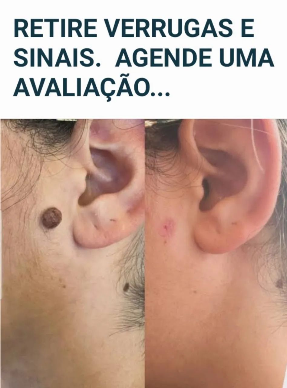 Retire Verrugas e Sinais. Limpeza de Pele Profissional Bem Profunda 