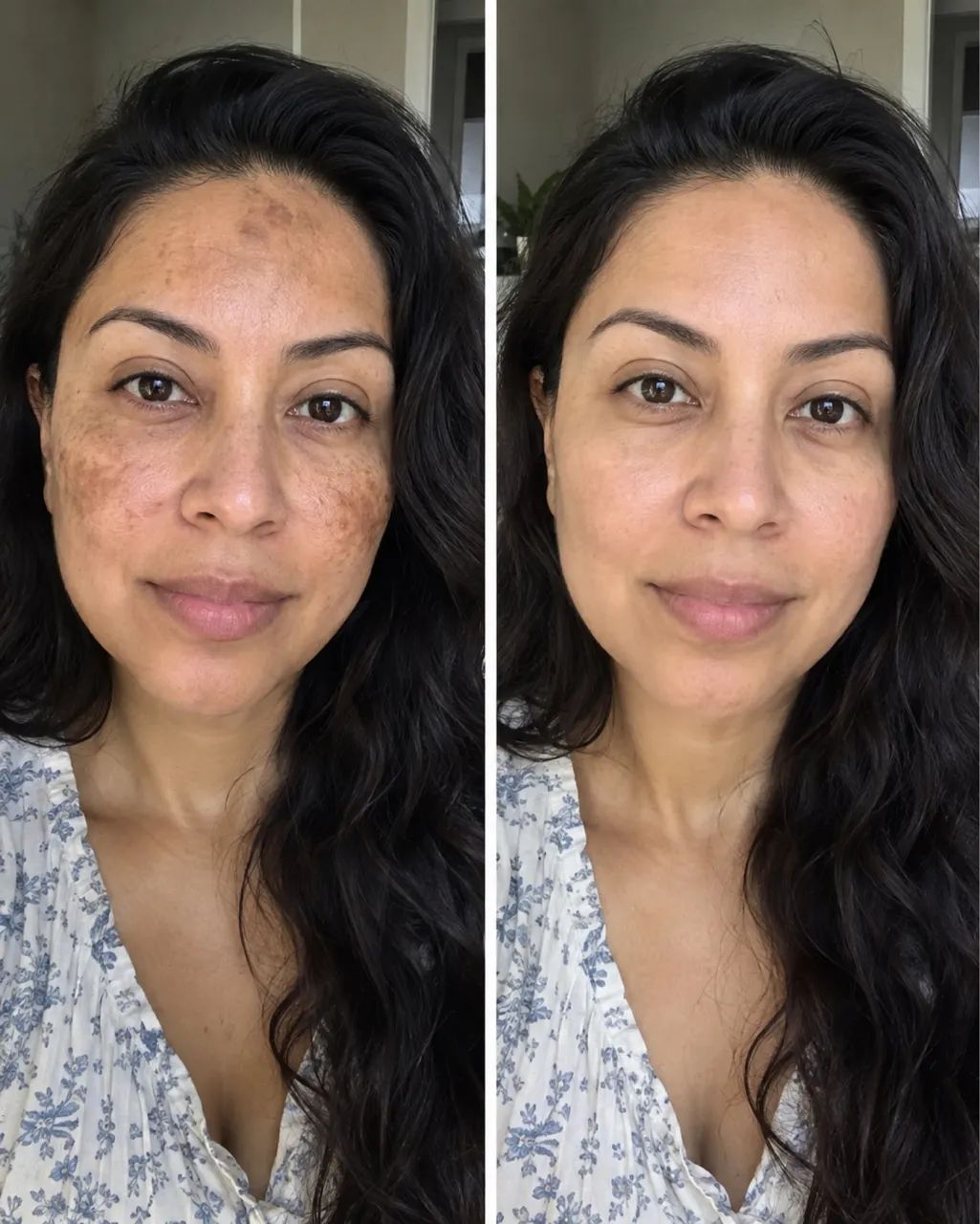 Remova melasma - Foto 3