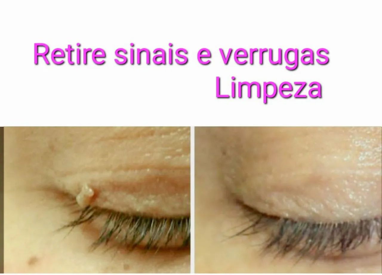 Retire Verrugas e Sinais. Limpeza de Pele Profissional Bem Profunda  - Foto 2