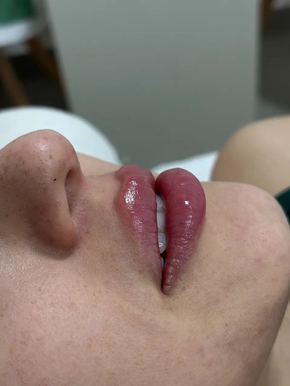 PREENCHIMENTO LABIAL  - Foto 2