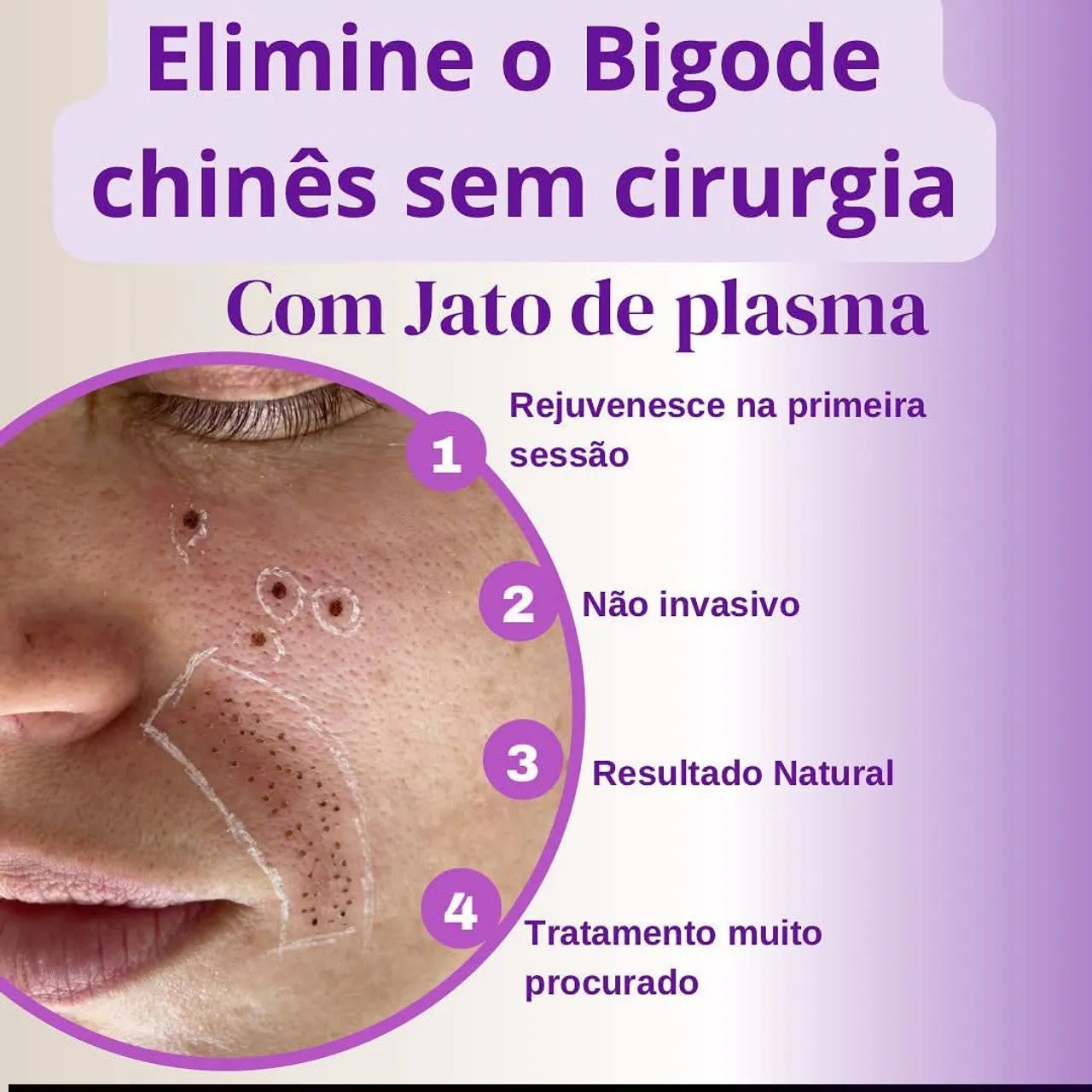 Blefaroplastia Modelos  - Foto 3