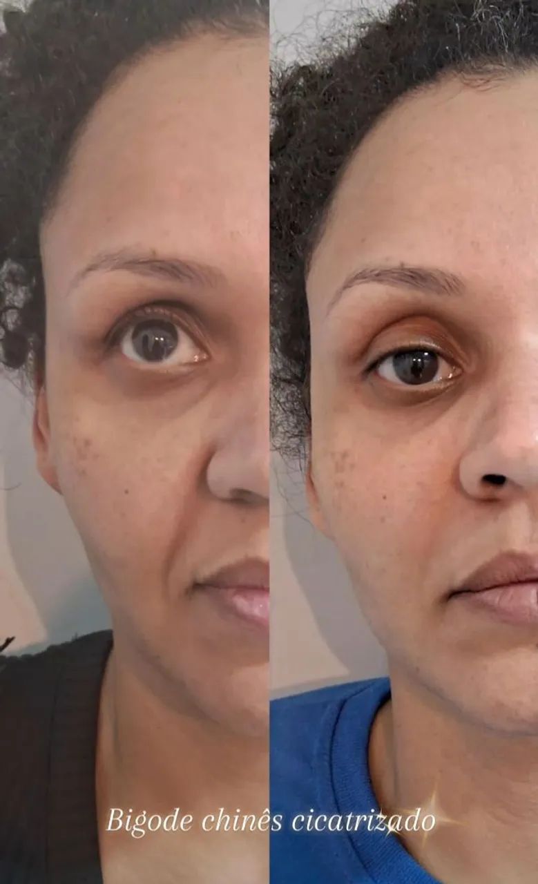Preenchimentos Faciais, corporais e íntimo - Foto 4