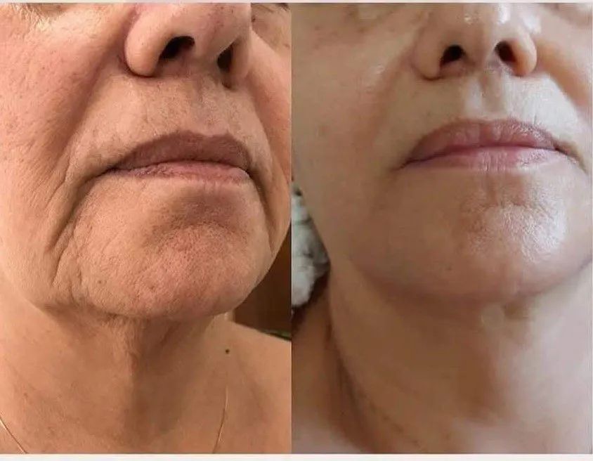 Blefaroplastia Modelos  - Foto 4