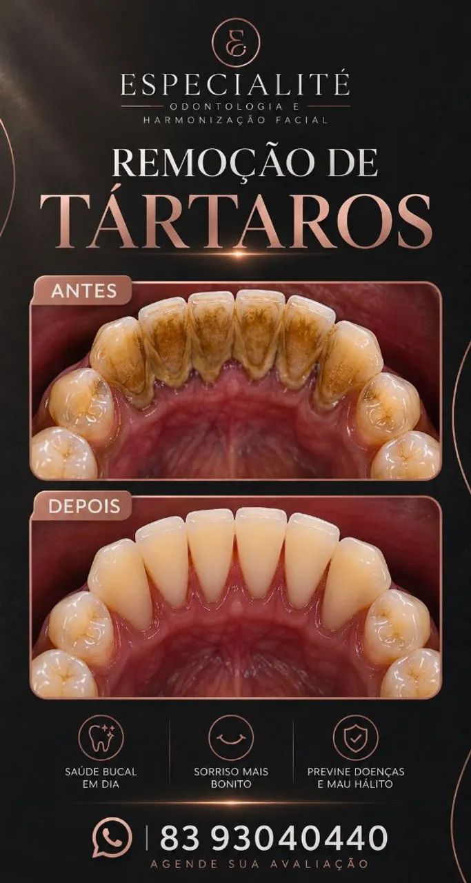 Remoção de Tártaro em João Pessoa   - Dentista com hora marcada  