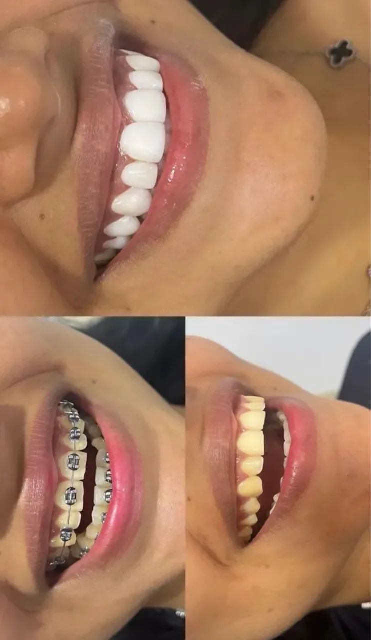 Facetas em Resina - Foto 3
