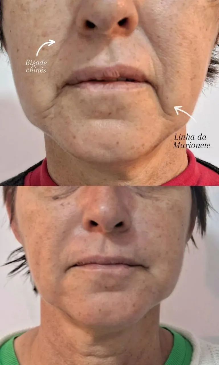 Preenchimentos Faciais, corporais e íntimo - Foto 5