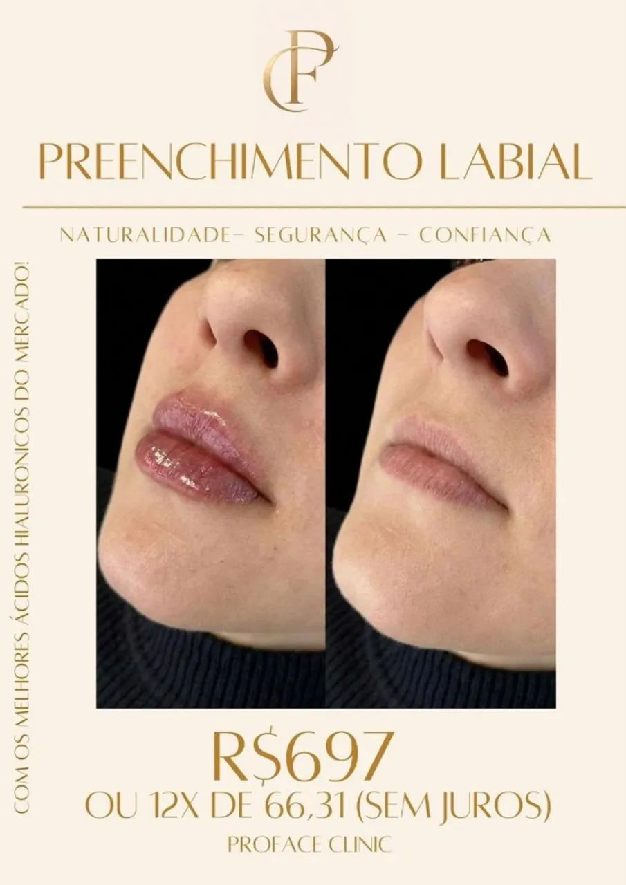  PREENCHIMENTO LABIAl
