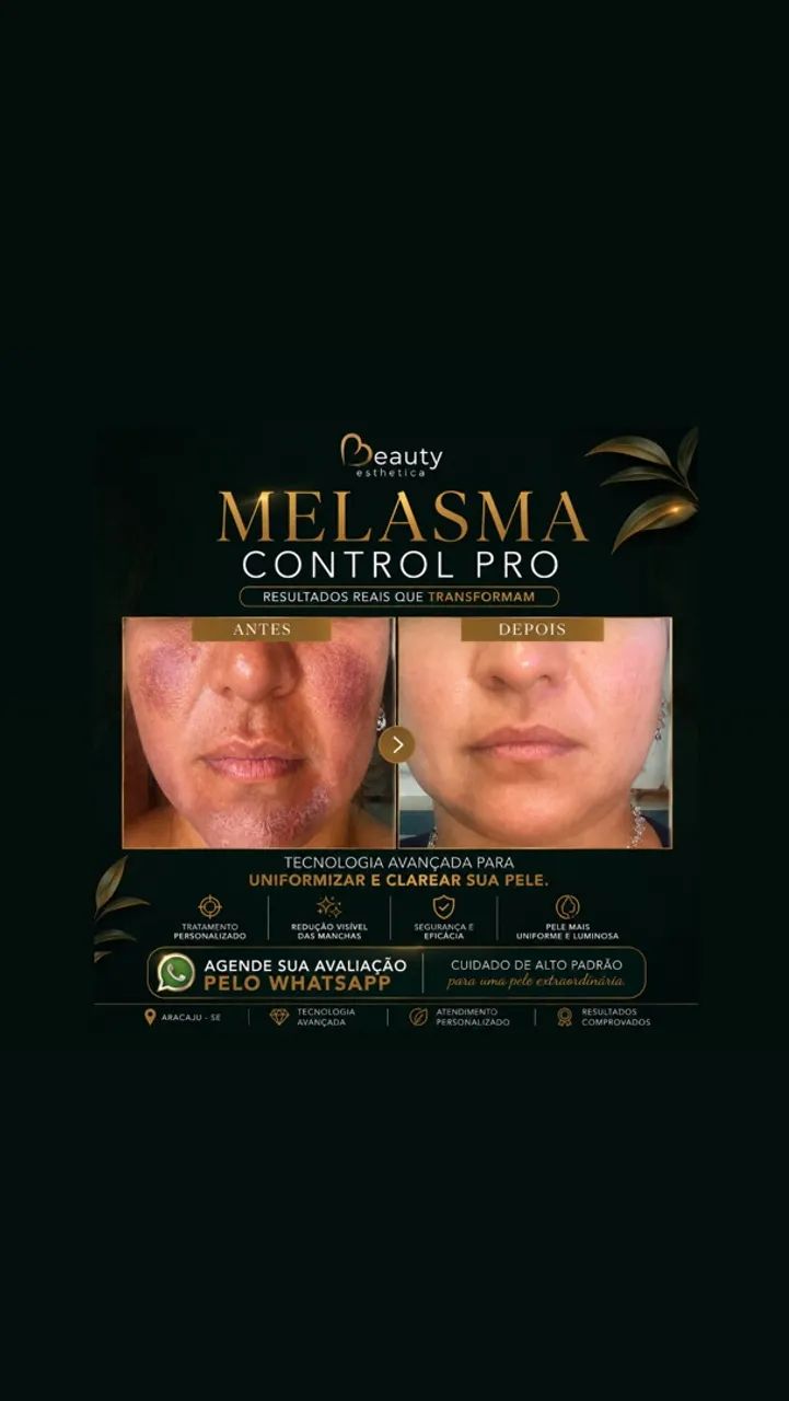 Tratamento Melasma | ARACAJU 