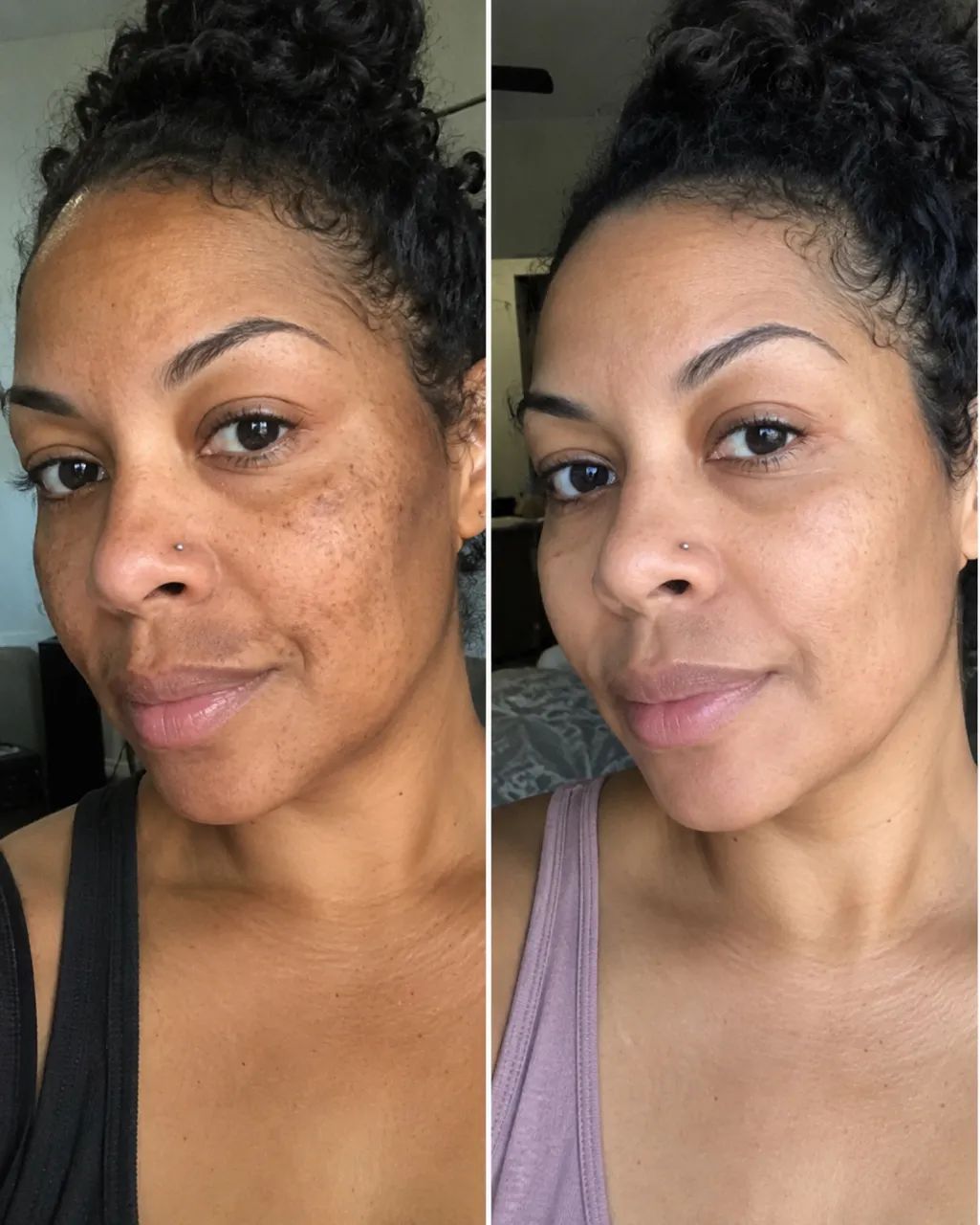 Remova melasma - Foto 4