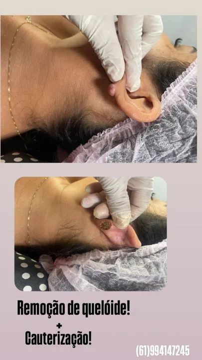 Remoção de quelóide + Cauterização
