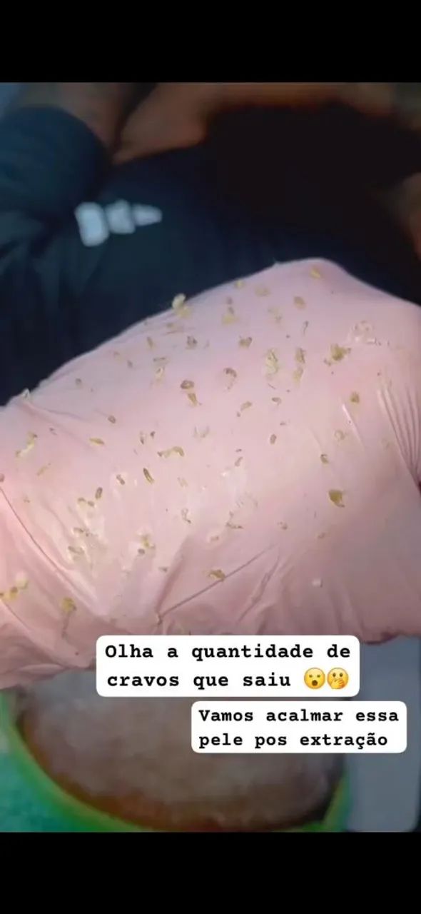 Limpeza de pele com extração  - Foto 2