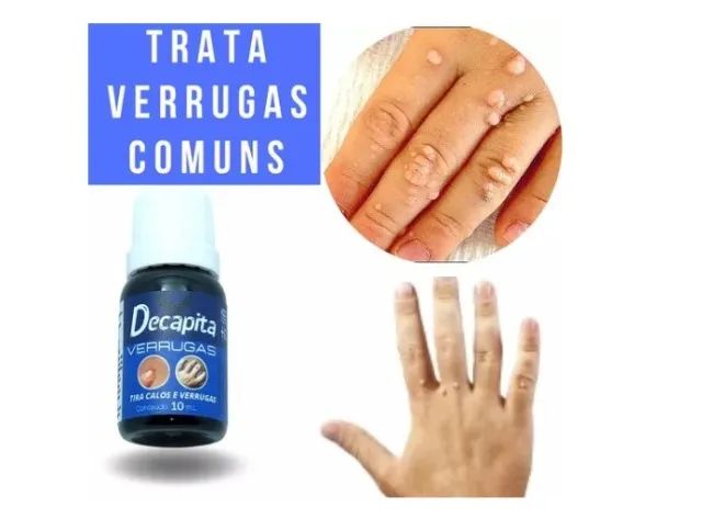 Decapita Removedor de Verrugas Pointss - Foto 5