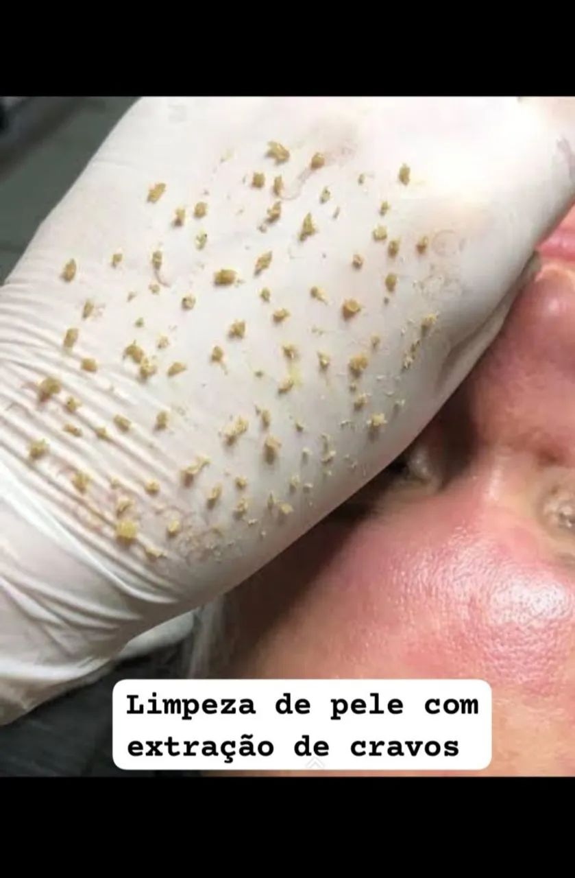 Limpeza de pele com extração  - Foto 3