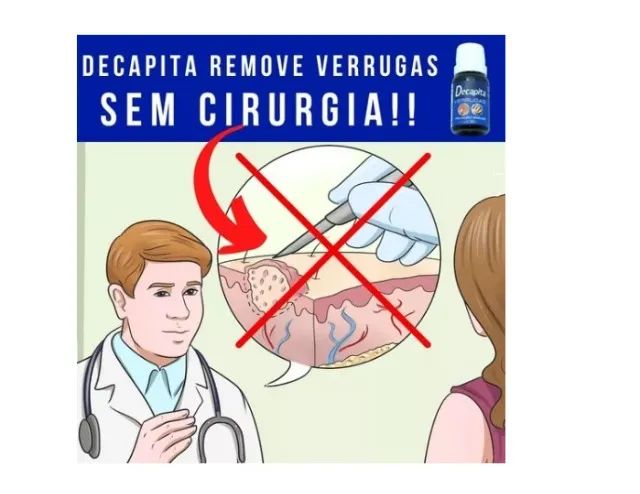 Decapita Removedor de Verrugas Pointss - Foto 3