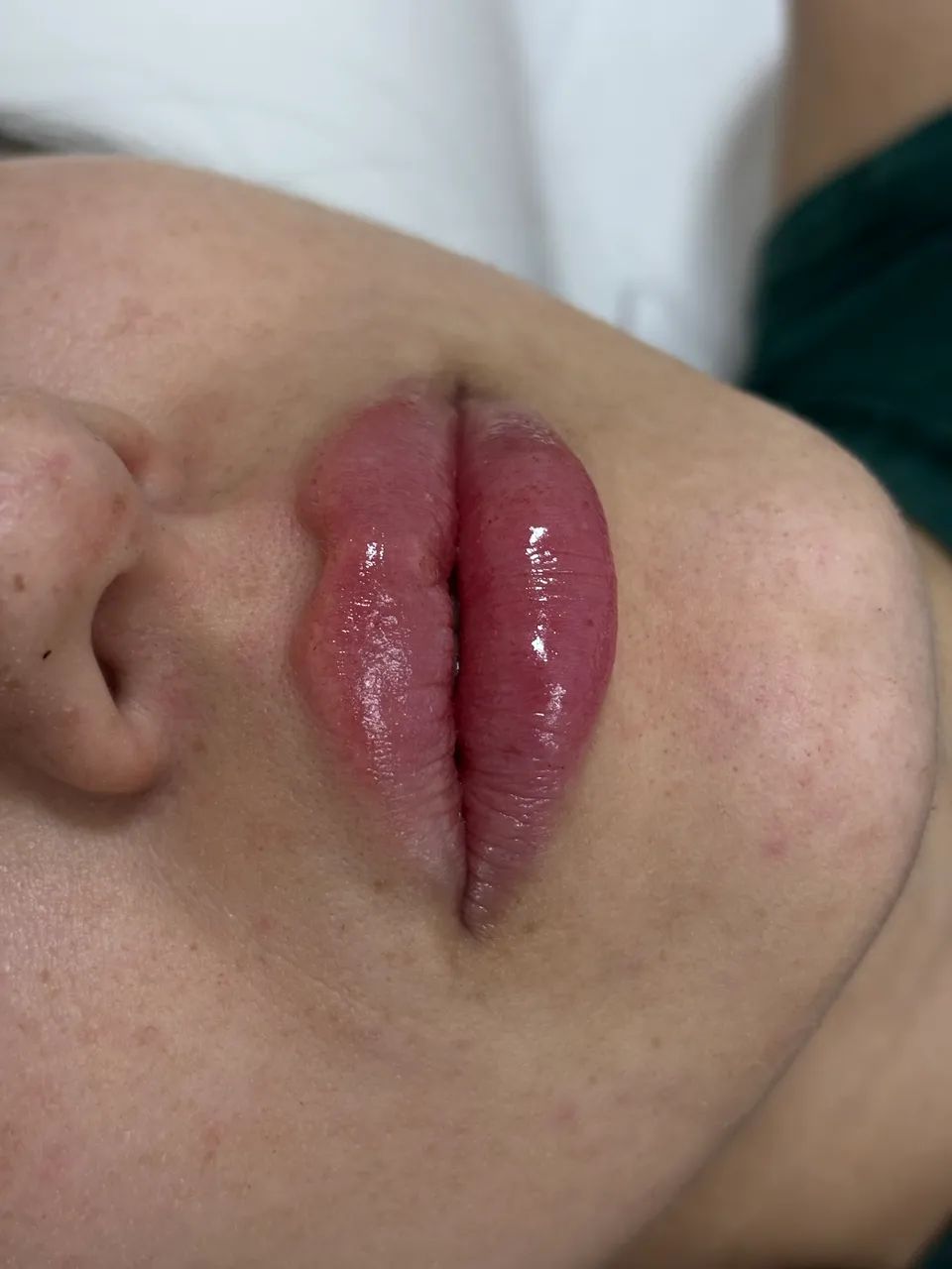PREENCHIMENTO LABIAL  - Foto 3