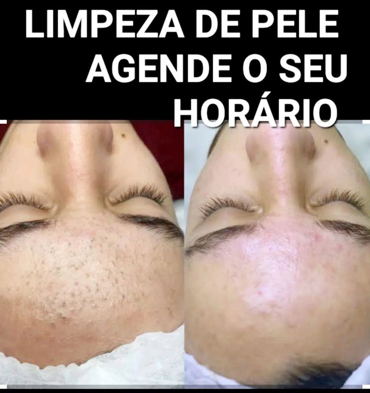 Retire Verrugas e Sinais. Limpeza de Pele Profissional Bem Profunda  - Foto 3