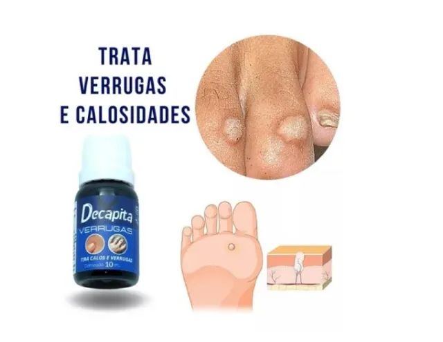 Decapita Removedor de Verrugas Pointss - Foto 4