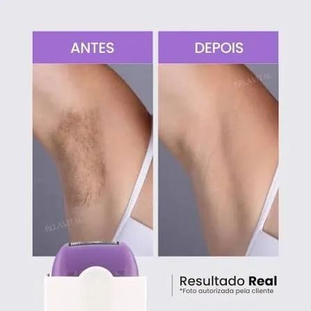 Depilado Laser FLEX - Foto 3