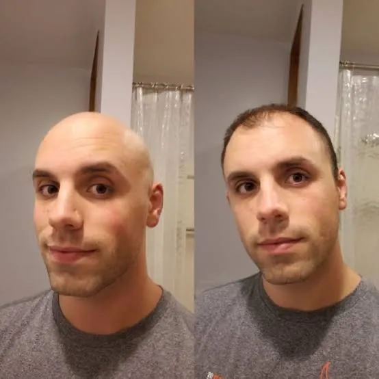 Kit de produtos para cabelo: Antes e Depois