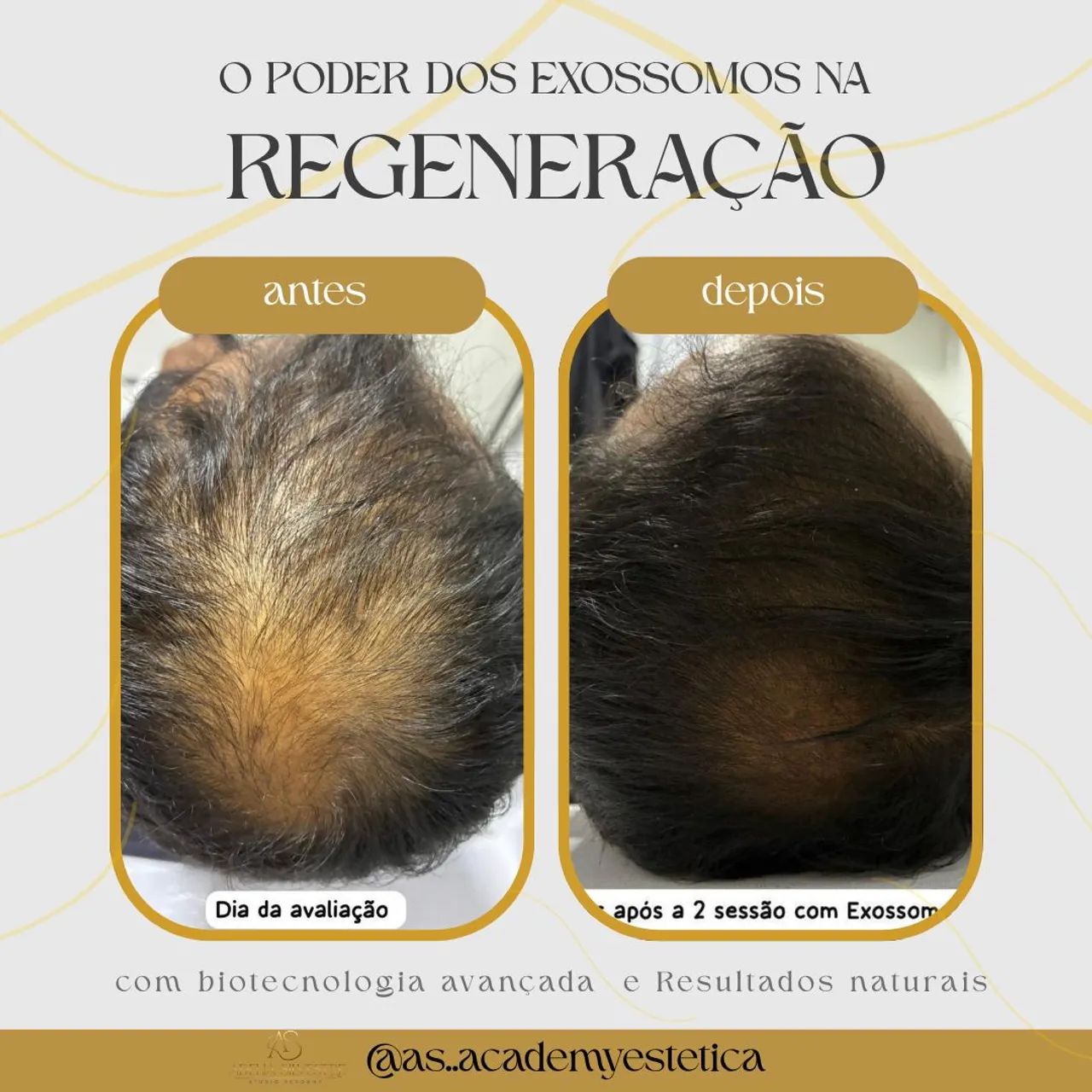 *Tratamento de Alopesia Com a Regeneração*