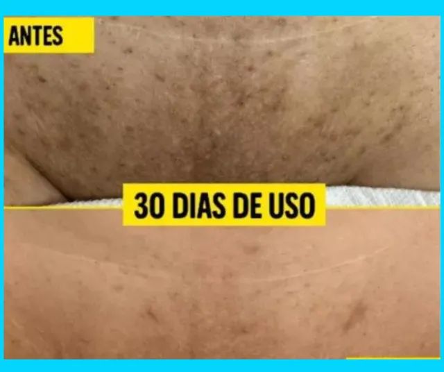 Clareador de Manchas de pele - PAGUE NA ENTREGA - Foto 4