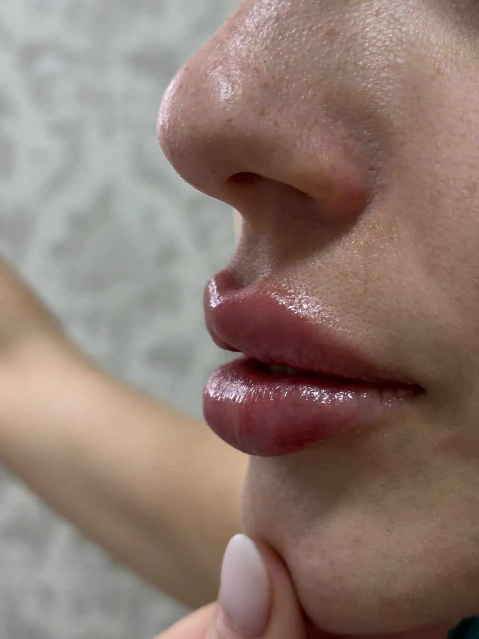 PREENCHIMENTO LABIAL  - Foto 4