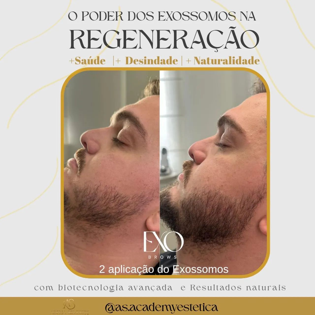 *Tratamento de Alopesia Com a Regeneração* - Foto 2