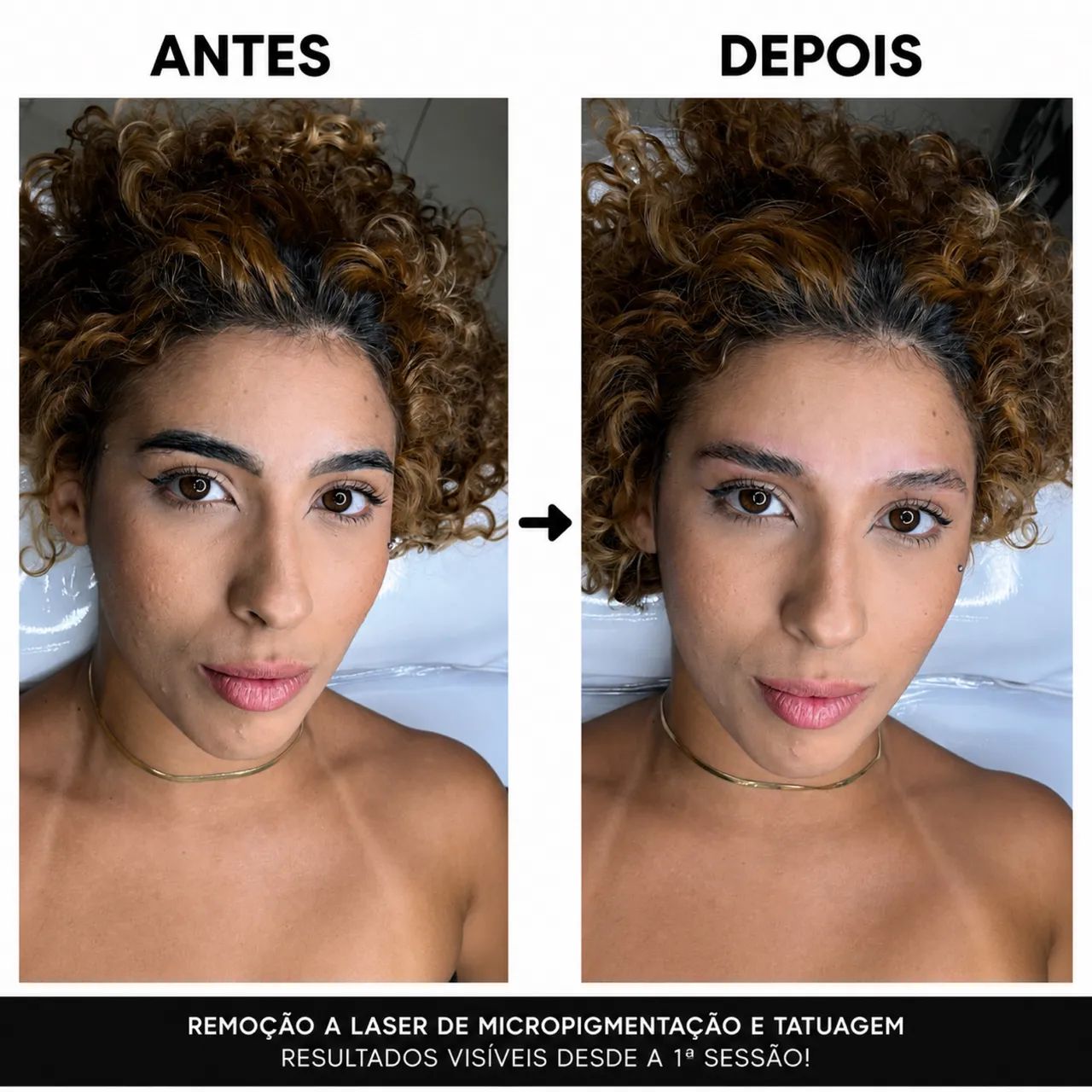 Remoção de Micropigmentação e tatuagem 