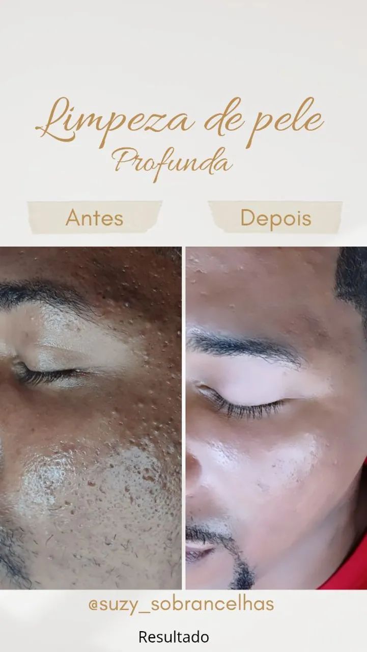 Limpeza de pele com extração  - Foto 5