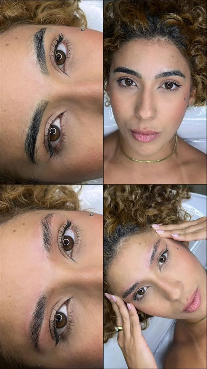 Remoção de Micropigmentação e tatuagem  - Foto 2