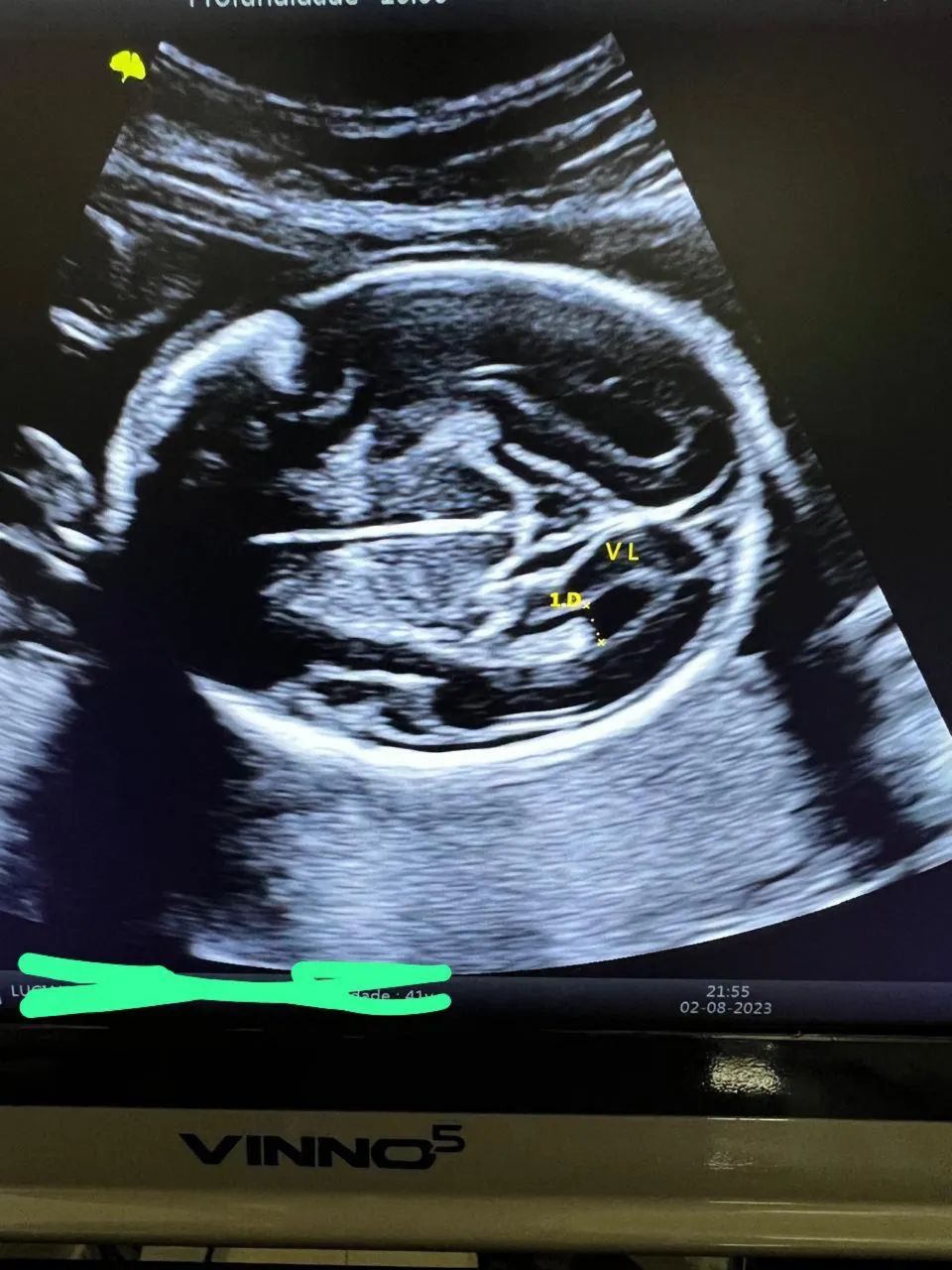 Ultrassom Vinno V5 4D - Foto 2