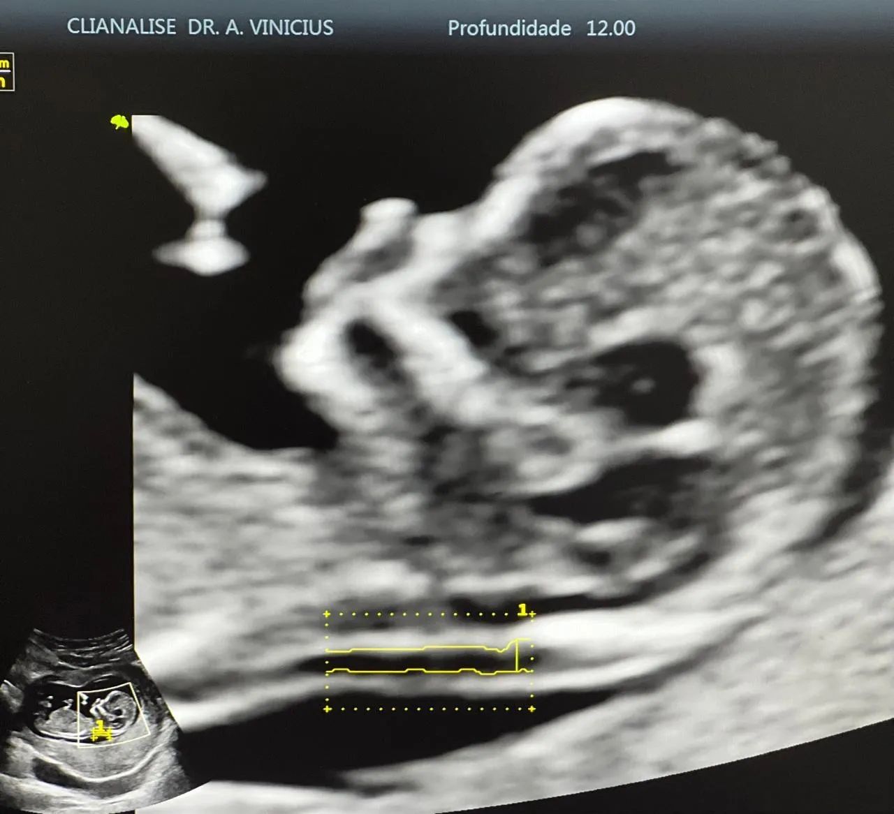 Ultrassom Vinno V5 4D - Foto 4