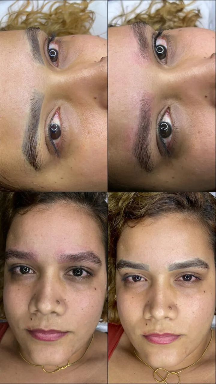 Remoção de Micropigmentação e tatuagem  - Foto 3