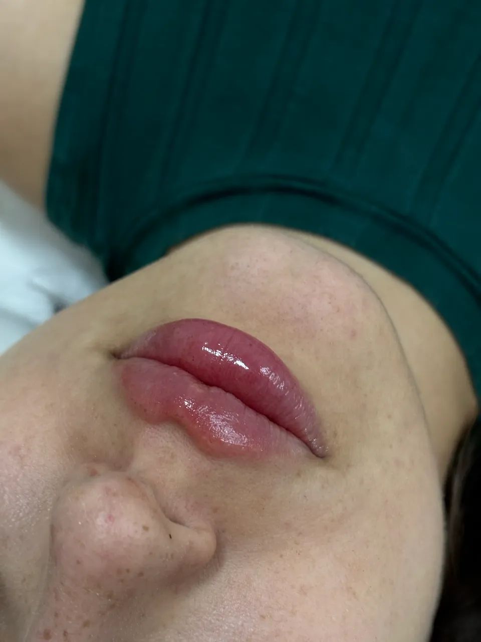 PREENCHIMENTO LABIAL  - Foto 5