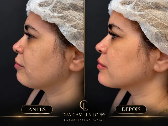 Harmonização facial  - Foto 2