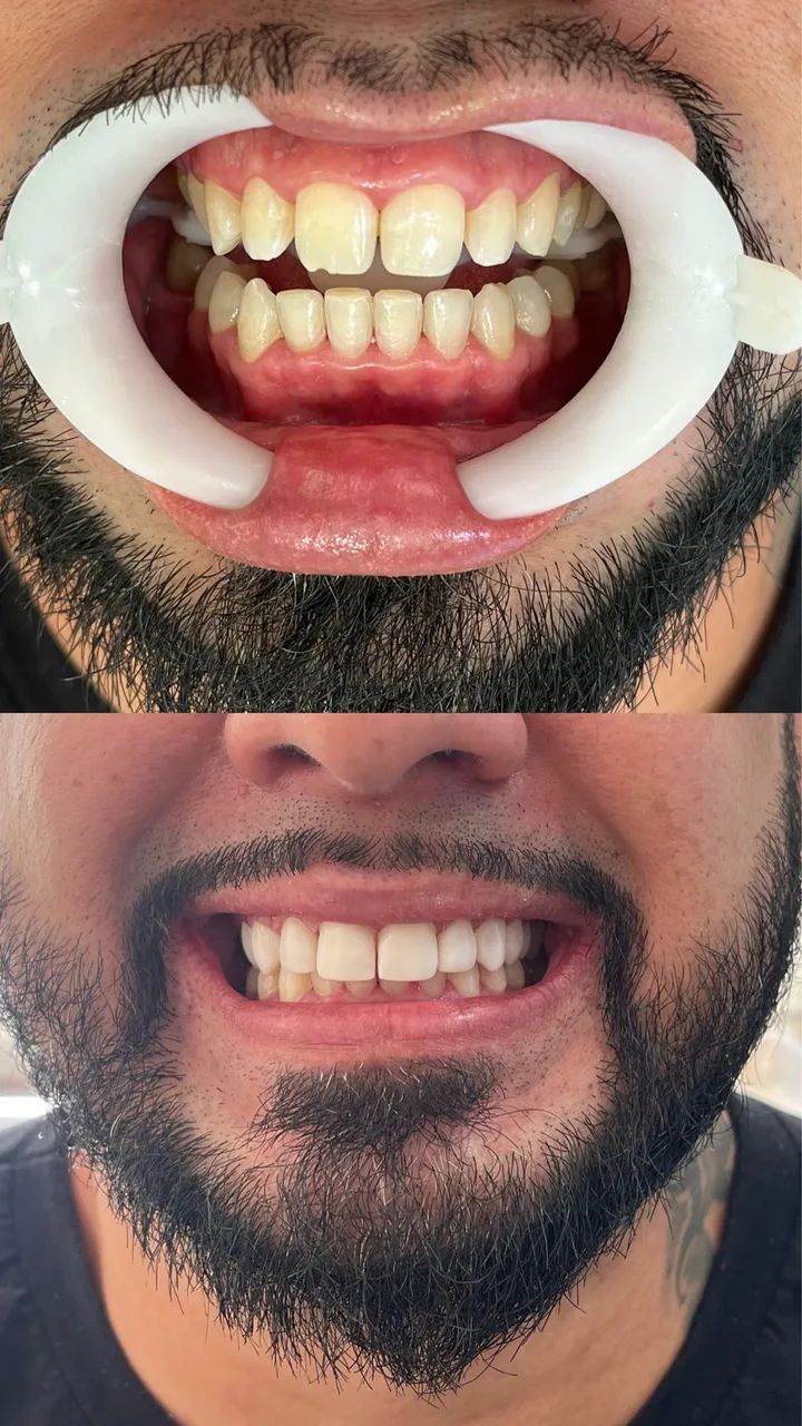 Facetas em resina  - Foto 2