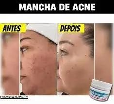 Clareador de Manchas de pele Amazon Kaps - PAGUE SÓ NA ENTREGA!!! - Foto 2