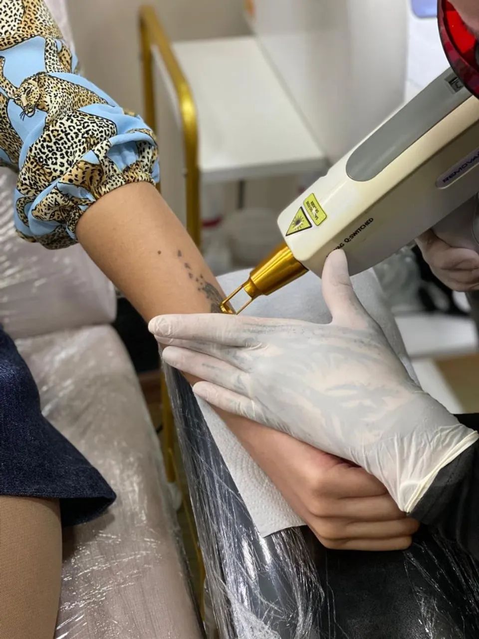 Máquina de Laser NdYag Remoção de Tatuagem ANVISA com acessórios!