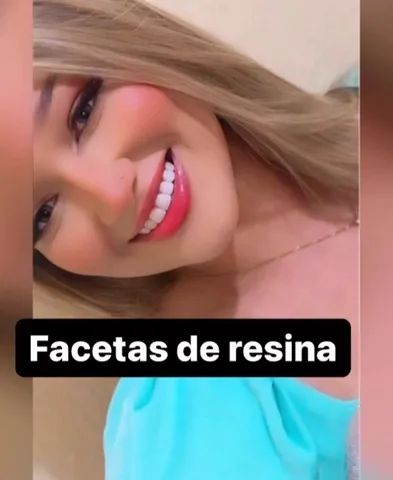 Facetas de resina 