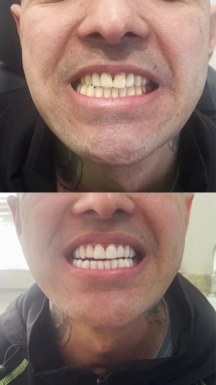Facetas em resina  - Foto 3