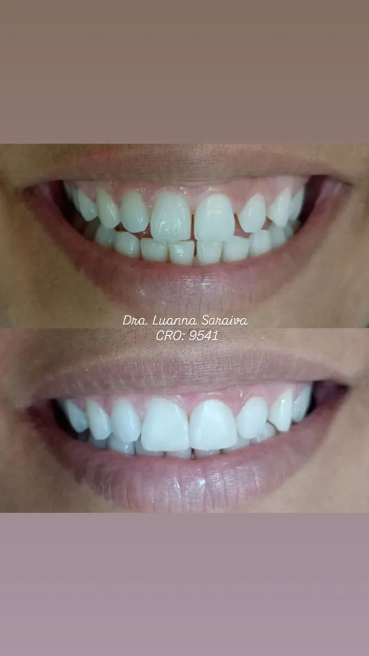 Facetas | restaurações | clareamento 