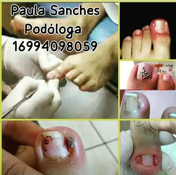 Paula Sanches Podóloga cuidando da saúde dos seus pés ? - Foto 4
