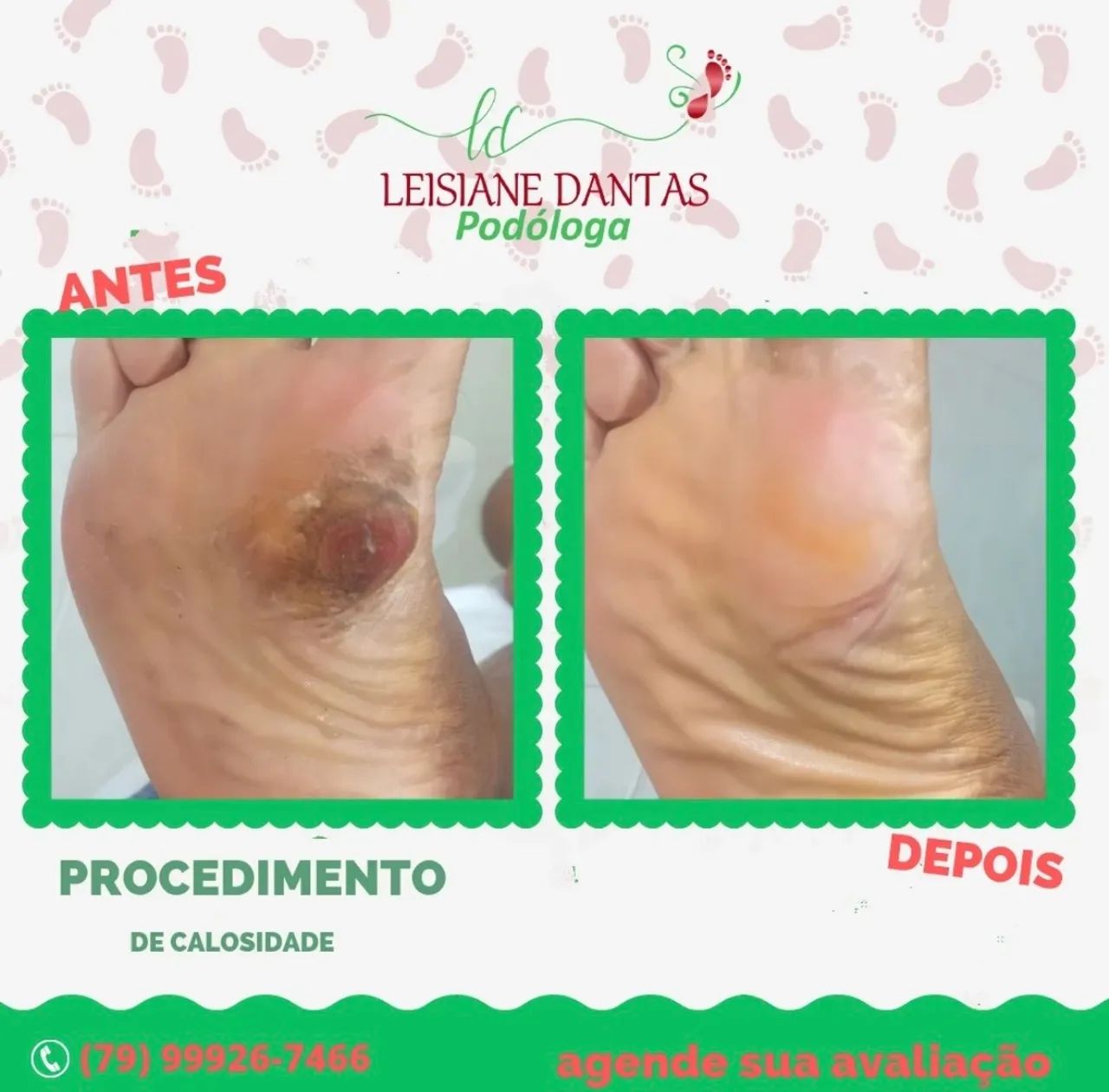 Tratamento de calosidade com Leisiane Dantas Podóloga