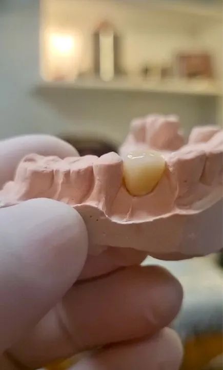 Protese dental (próteses, bride, dentaduras, pererecas, chapas, provisórios, implantes et - Foto 2