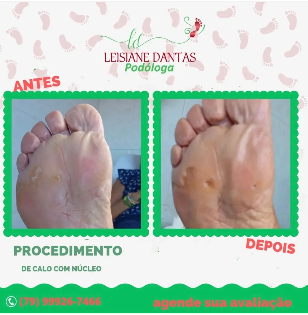 Tratamento de calosidade com Leisiane Dantas Podóloga - Foto 3