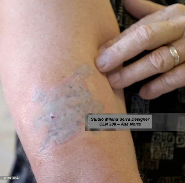 Remoção de tatuagem a lesar  micropigmentação - 99, a sessão. - Foto 3