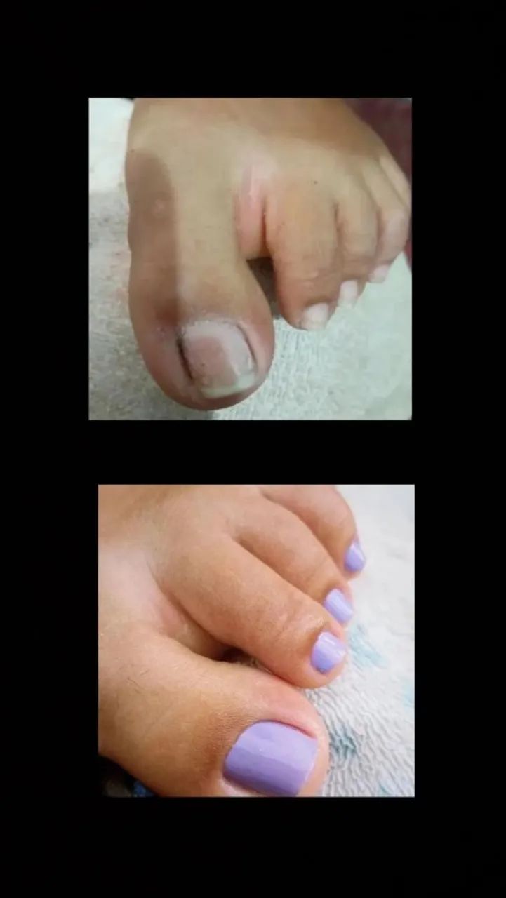 Unhas - Foto 3
