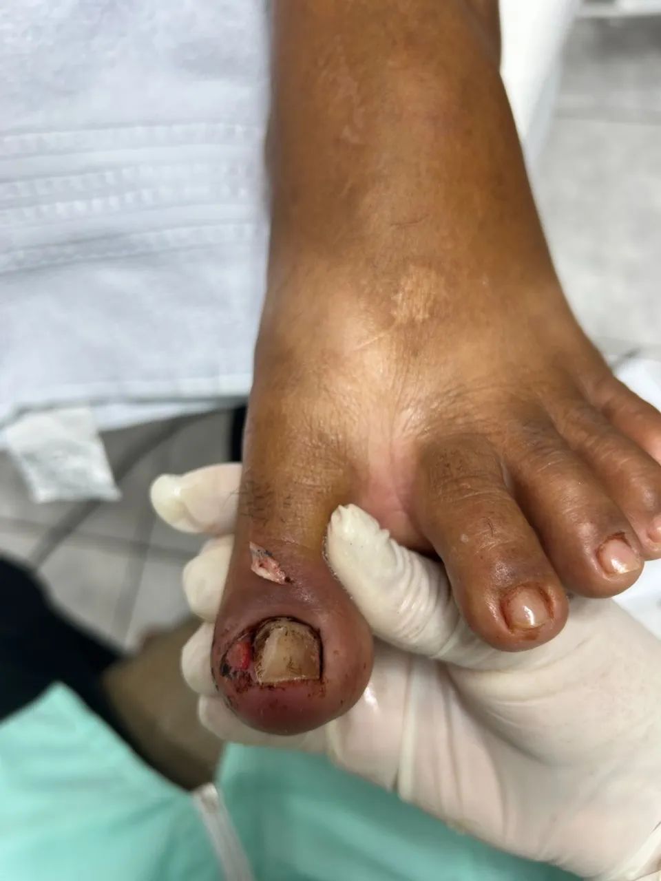 Tratamento de calosidade com Leisiane Dantas Podóloga - Foto 5